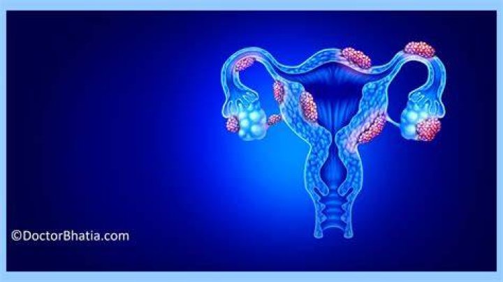 Can homeopathy cure endometriosis permanently