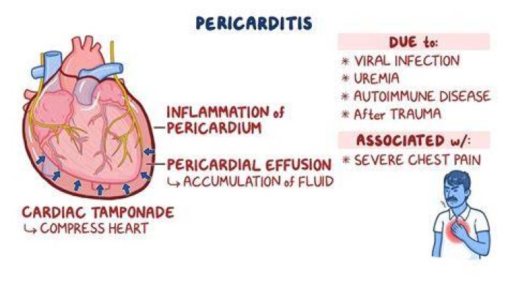 Can you get pericarditis from rheumatic fever