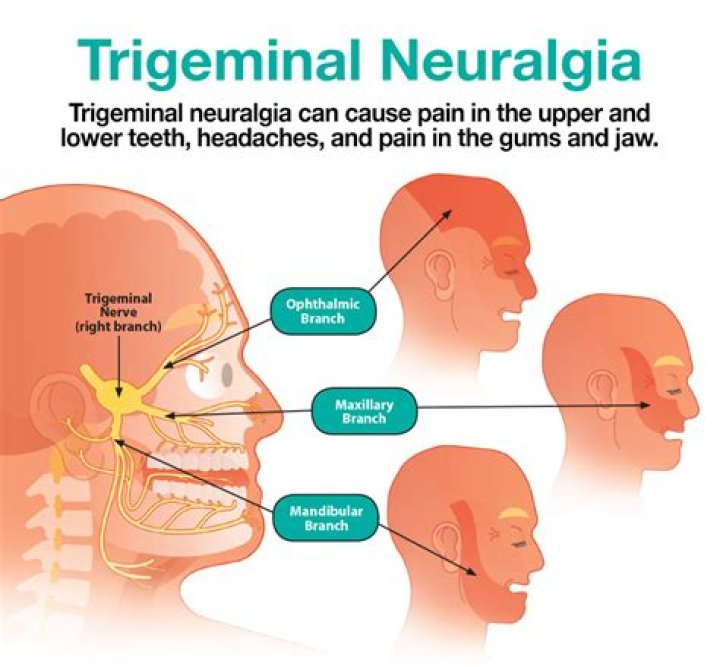 How bad is the pain from trigeminal neuralgia