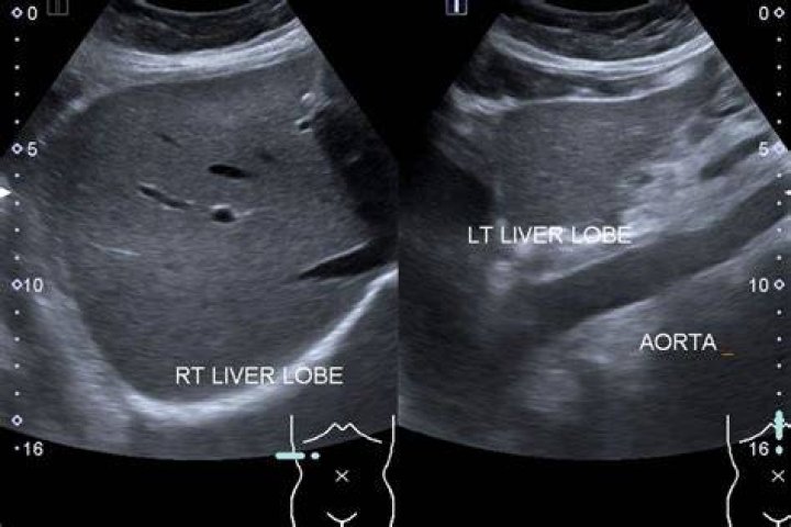 How long does a liver Doppler ultrasound take
