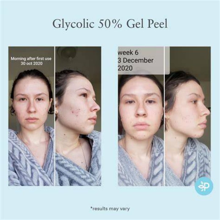 How often can you do a 30% glycolic acid peel