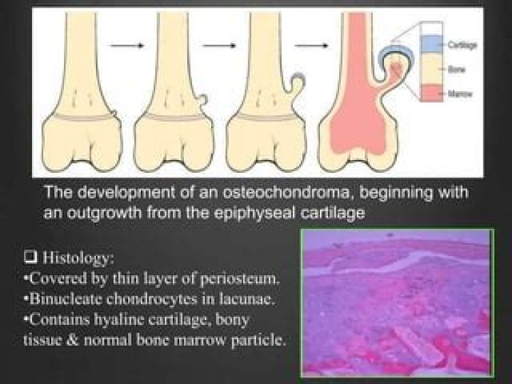 How often do Osteochondromas become cancerous