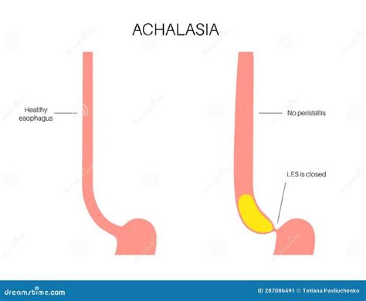 Is esophageal achalasia an autoimmune disease