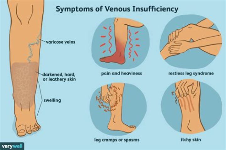 What does venous insufficiency pain feel like
