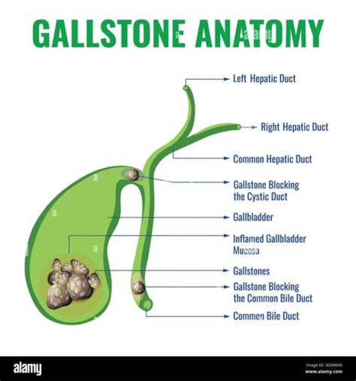 What happens when a stone is in the bile duct