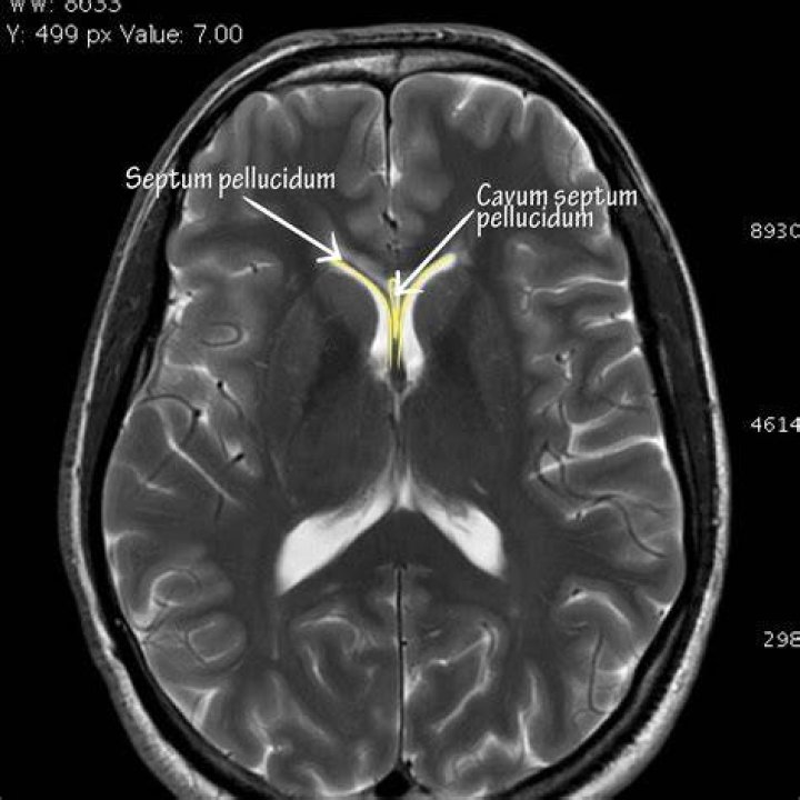 What is the septum pellucidum responsible for