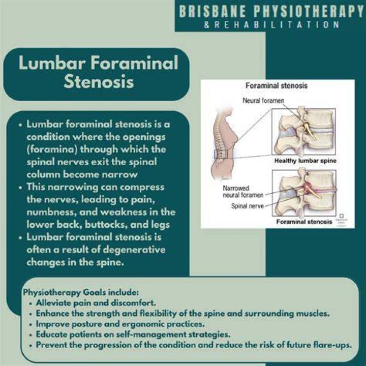 What is the treatment for Foraminal narrowing